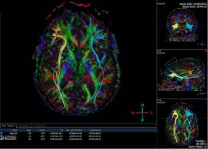 diffusion tensor imaging legal | traumatic brain injury scan